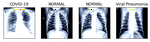 Covid-19 Diagnosis using Radiography Images
